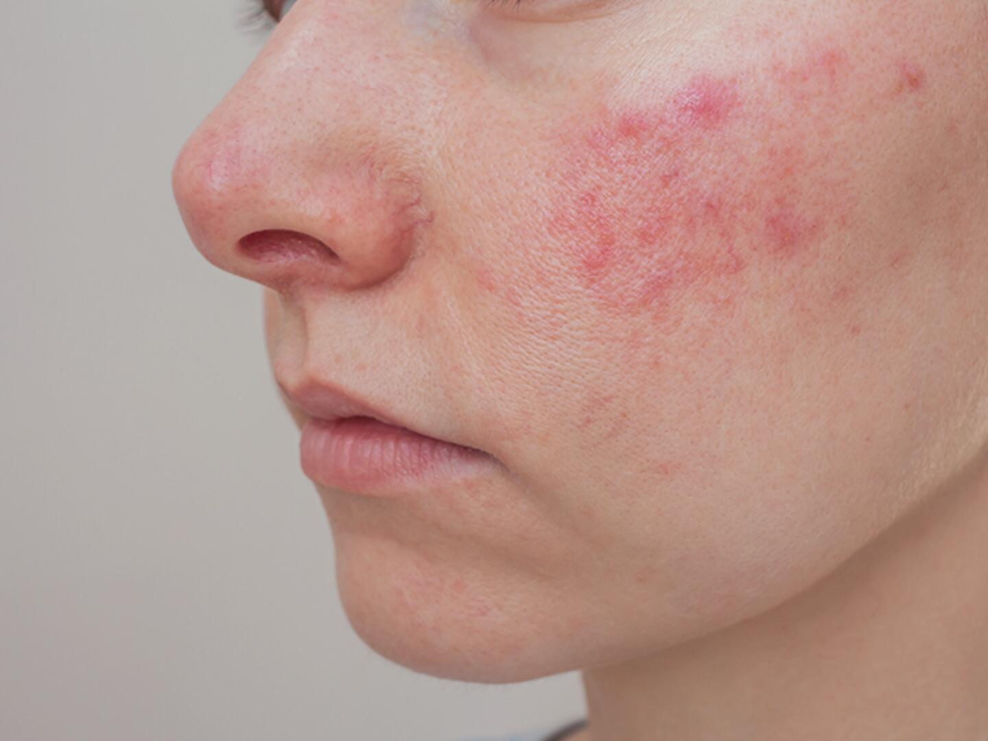 Nahaufnahme einer Frau mit geröteter Wange, die eine weiße Creme mit einem Spatel auf die entzündete Hautstelle aufträgt